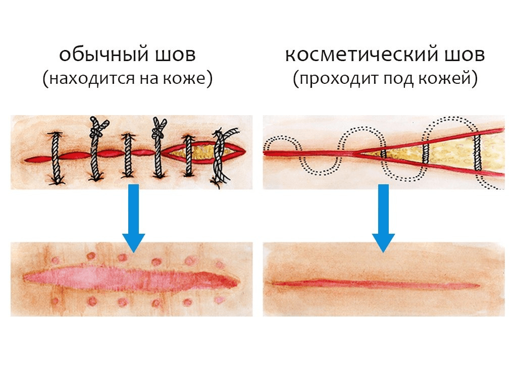 Ушивание кожных ран